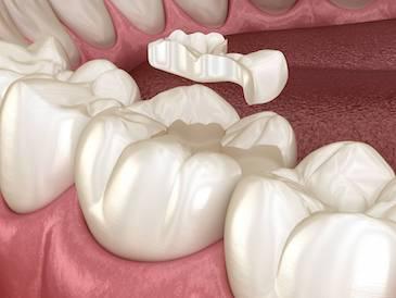 Diagram of a tooth inlay in Langhorne PA