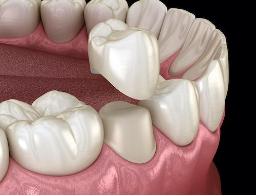 Diagram of dental crowns at Desai Dental Care