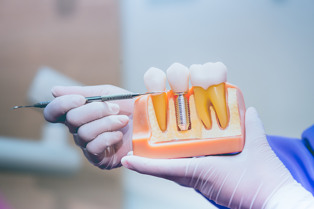 dental implant model in Langhorne