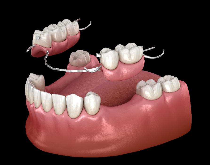A diagram of partial dentures in Langhorne PA