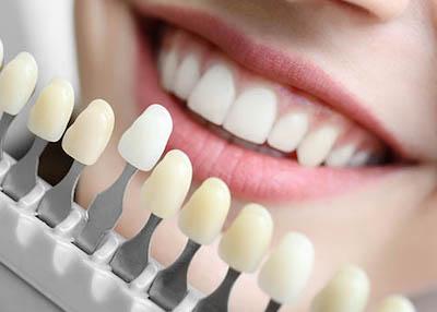A patient comparing teeth shades before a teeth whitening