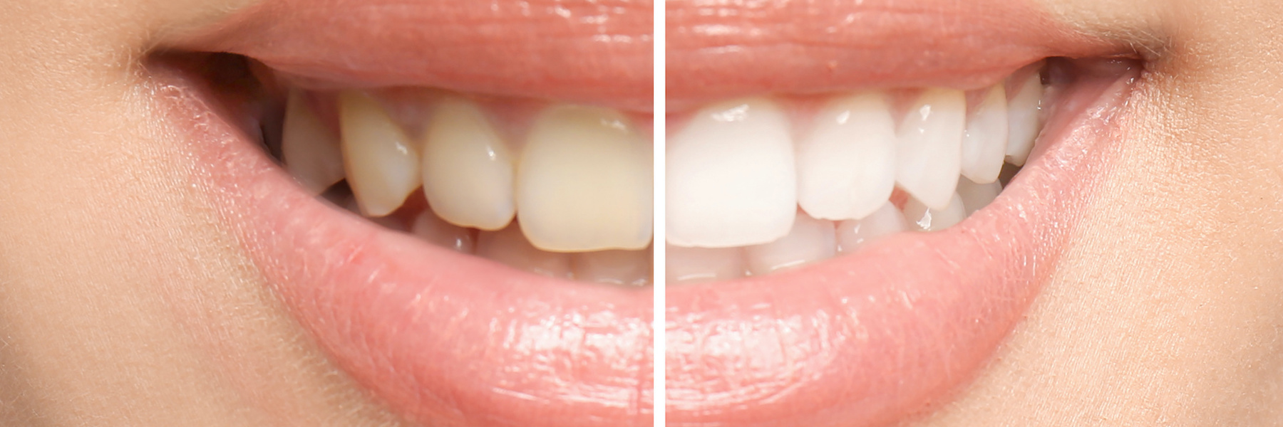 Before and after cosmetic dentistry comparison for patient