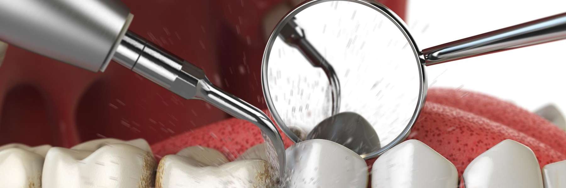 Diagram of a dental cleaning in Langhorne PA