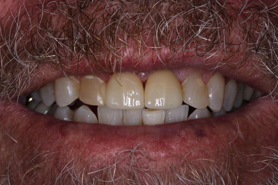 Patient after receiving dental crowns in Langhorne