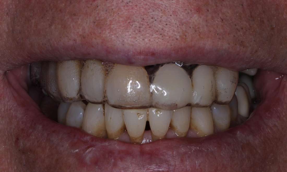 Patient smile after getting dentures