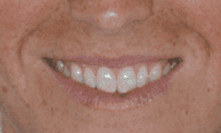 Patient smile after getting Invisalign