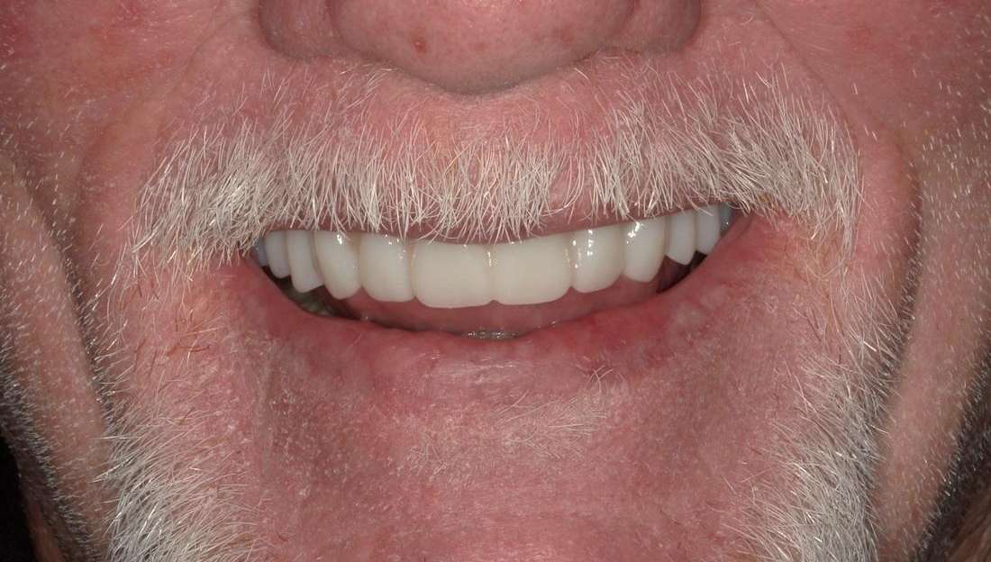 Patient after restoration with implant-supported denture