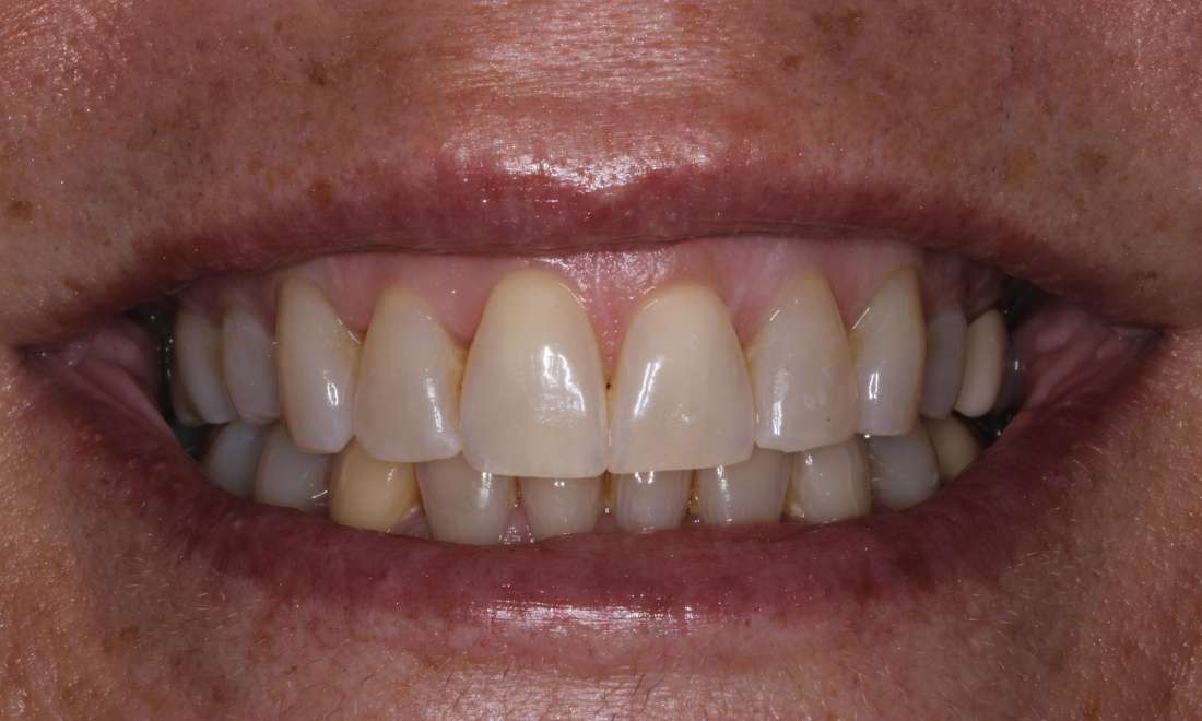 Patient smile after getting Invisalign in langhorne