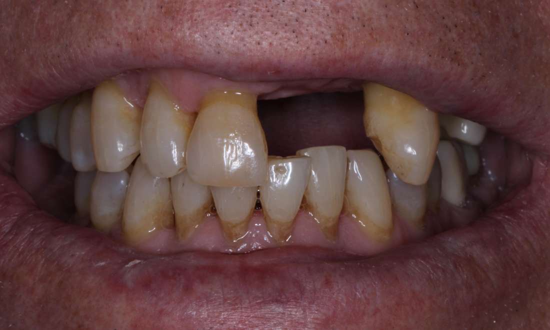 Patient smile before getting dentures