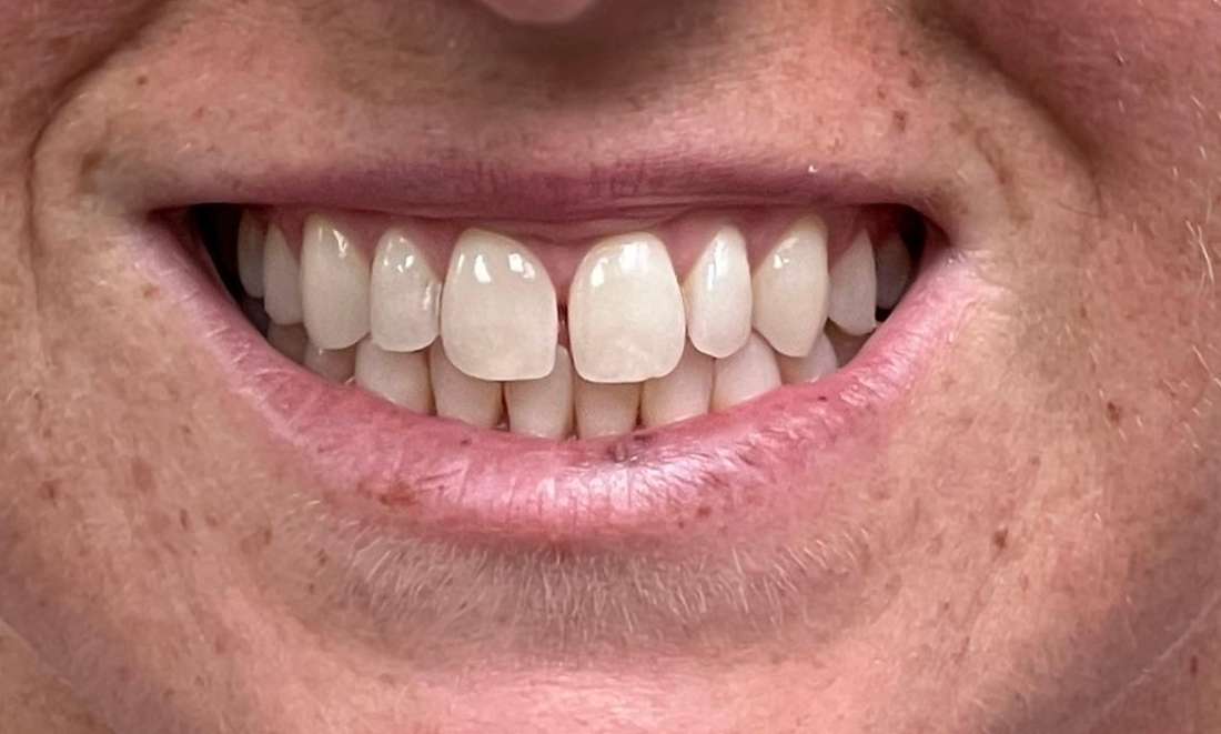 Patient smile before getting Invisalign