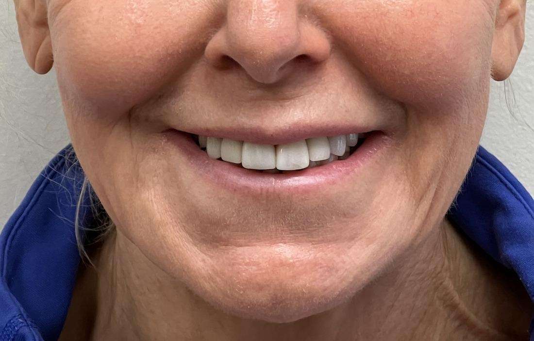 Woman before smile restoration