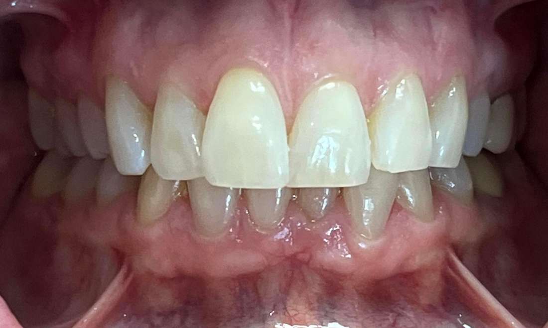Patient smile after getting langhorne Invisalign
