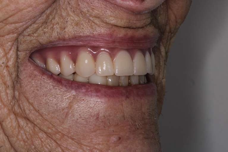 Patient smile after dentures in Langhorne