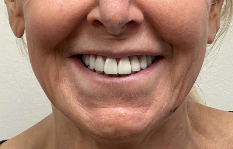 Patient after smile restoration