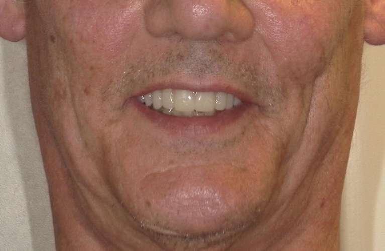 Patient after full mouth rehabilitation with crowns and bridges