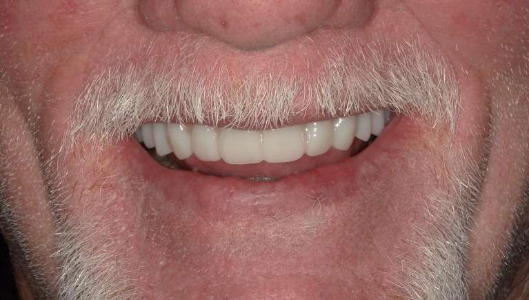 Patient after restoration with implant-supported denture
