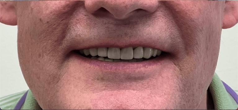 Patient after repairing his tooth at Desai Dental Care