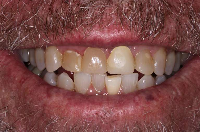 Crowns-Before-Image