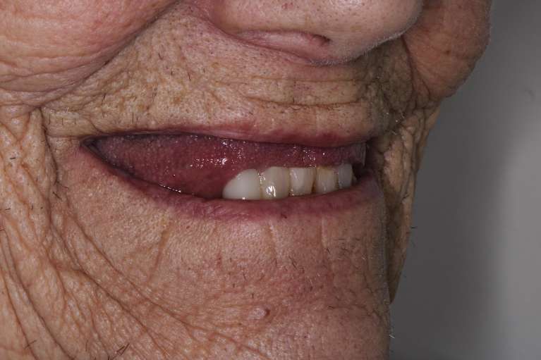 Patient smile before dentures in Langhorne