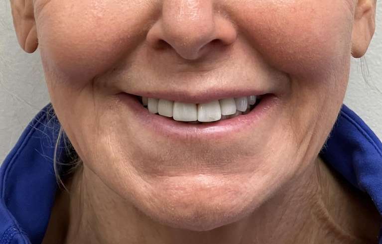 Woman before smile restoration