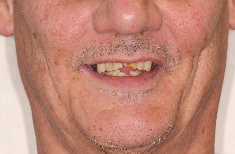 Patient before full mouth rehabilitation