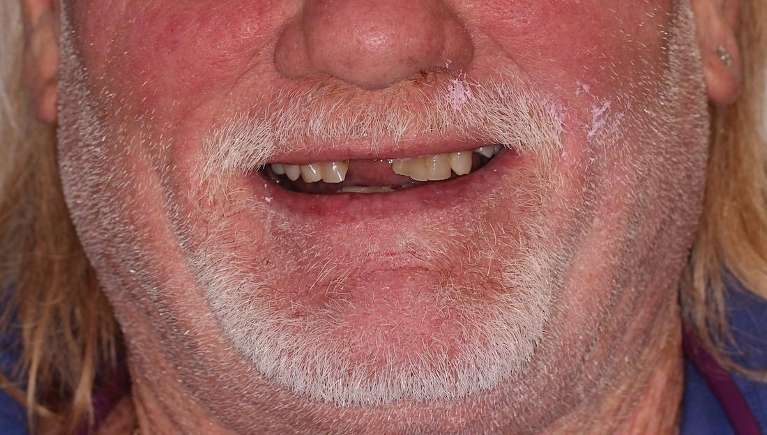 Patient with failing dentition