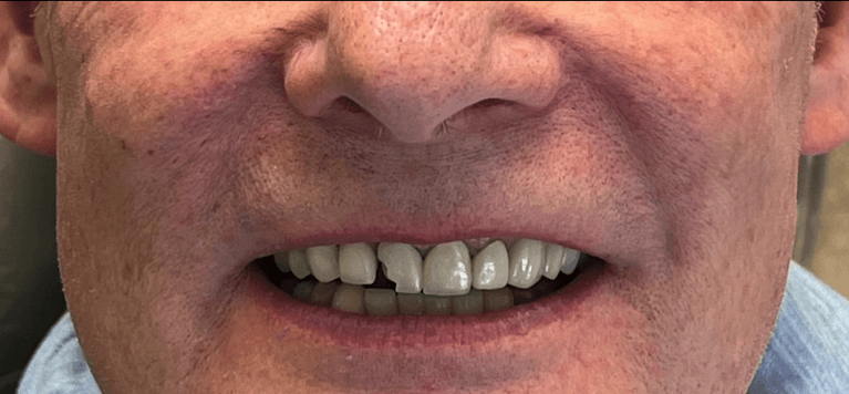 Patient with a broken tooth